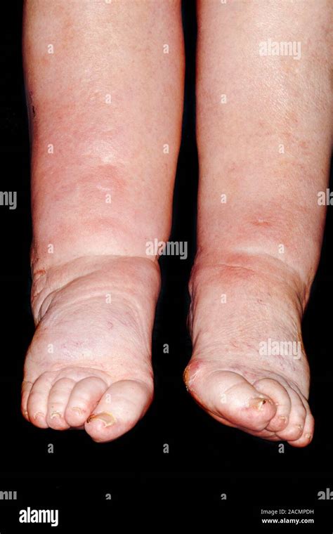 Bilateral Swelling Of The Lower Limbs Legs Ankles And Feet Due To