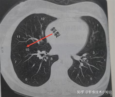 怎么在ct上识别肺的分段和支气管 知乎