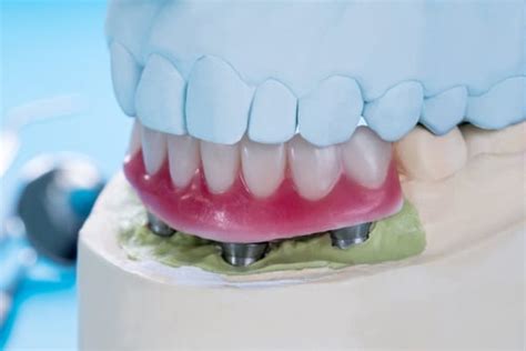 Implant Supported Dentures Vs Traditional Dentures Mulgrave Dental