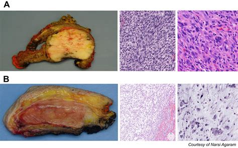 Management Of Myxofibrosarcoma And Undifferentiated Pleomorphic Sarcoma