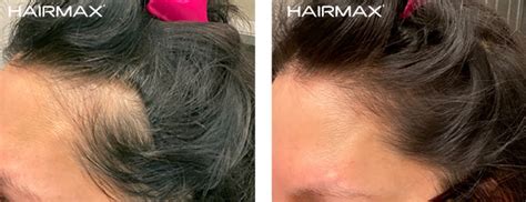 Before and After Plus Clinical Results Photos of Hair Growth– Hairmax