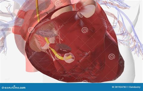 Pulmonary Artery Catheter Insertion Into The Right Ventricle Stock