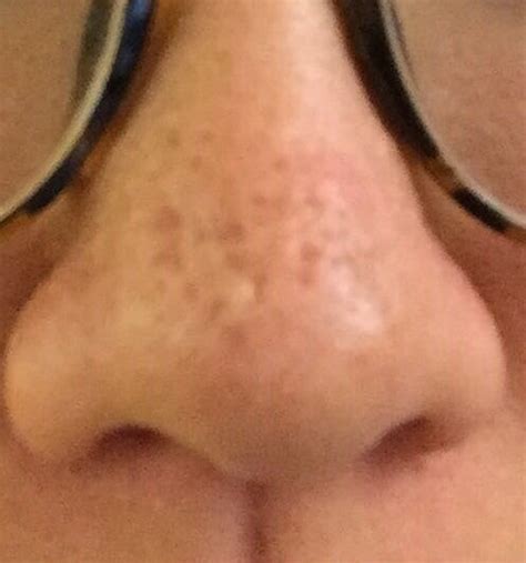 Acne Scars On Nose