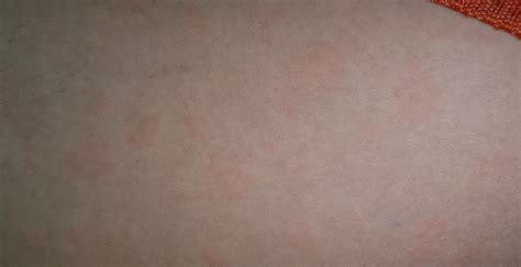 Hives, Lupus or what? : r/lupus