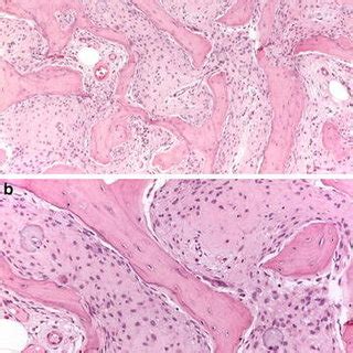 A low grade (grade 2) fibroblastic osteosarcoma, fibrous dysplasia-like ...