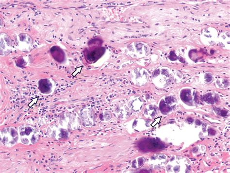 Squamous Cell Carcinoma Of The Bladder Complicating Schistosomiasis Airp Best Cases In