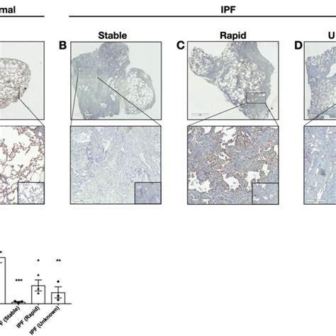 Dna Pkcs Expression Is Reduced In Ipf Lung Tissues A D Shown Are Download Scientific Diagram