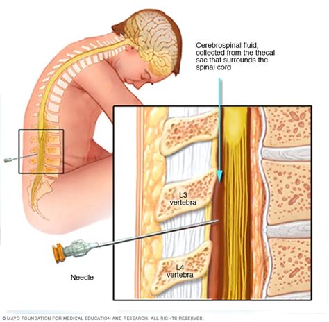 Infection Naegleria Fowleri Amibe Mangeuse De Cerveau Fmedic