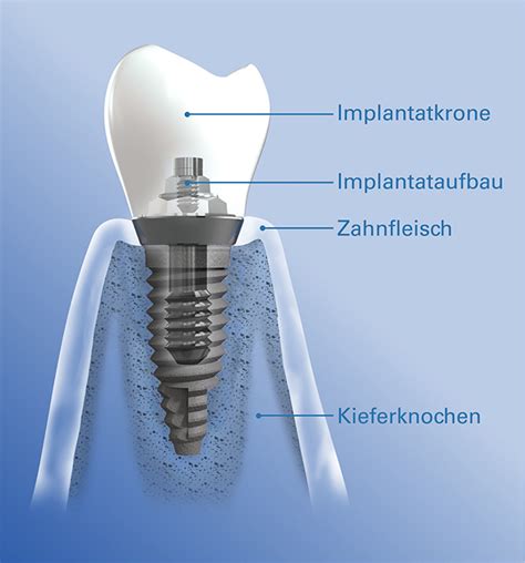 Implantate