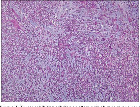 Figure 4 From Cribriform Adenocarcinoma Of Minor Salivary Gland A