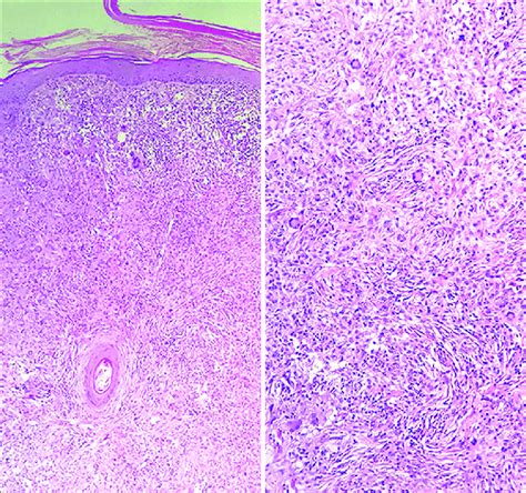 A Histopathological Examination Showing A Normal Epidermis With