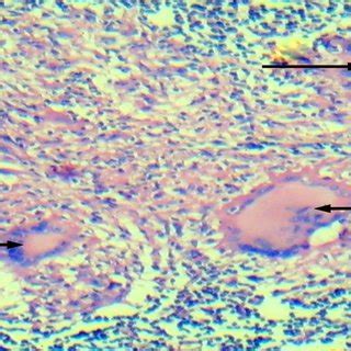 H & E stained section 10x showing multiple Langhan's Giant cells (Black ...