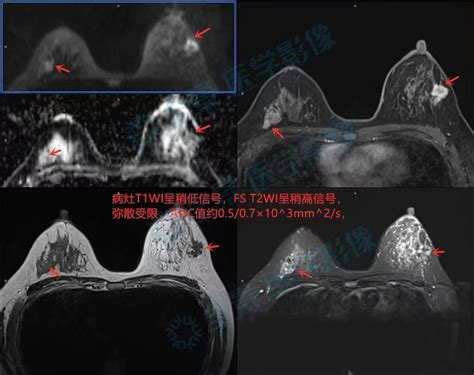 论乳腺磁共振动态增强检查重要性乳腺磁共振乳腺结节磁共振重要性乳腺癌淋巴结乳腺动态增强检查钼靶肿块彩超诊断病变 健康界