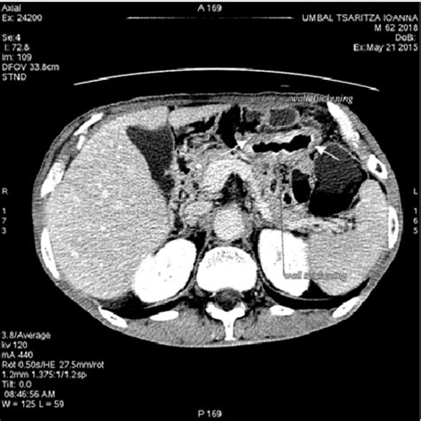 Ct Enterography Two Enlarged Mesenteric Lymph Nodes White Arrows