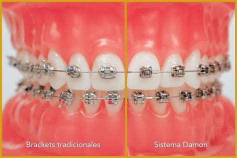 Ortodoncia fija con brackets en Córdoba Sistema Damon Eduardo López