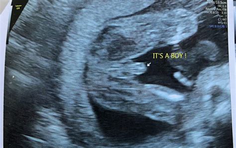 Pregnancy 2 The Second Trimester Cdds 20th Week Fetal Anomaly Scan