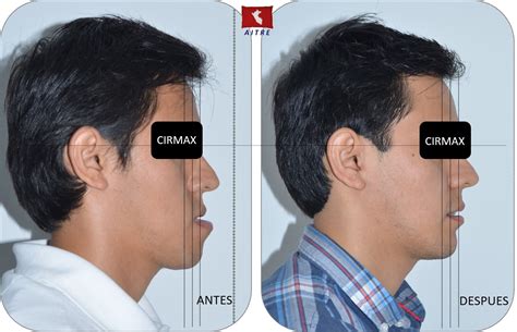 Asimetría Facial Centro Cirmax