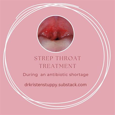 Strep throat treatment - by Dr. Kristen Stuppy