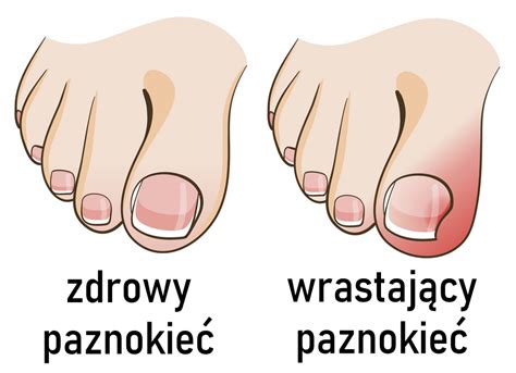 Jak Zadbać O Paznokcie U Nóg Domowe Sposoby Paznokcie Polska