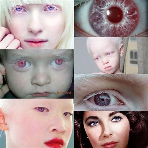 Albinism Eyes