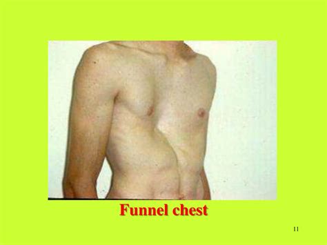 Funnel To Chest at Richard Fischer blog