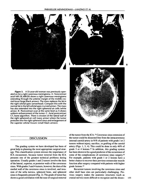 Paraseller Meningiomas Incidence Of Involvement Of Extracavernous