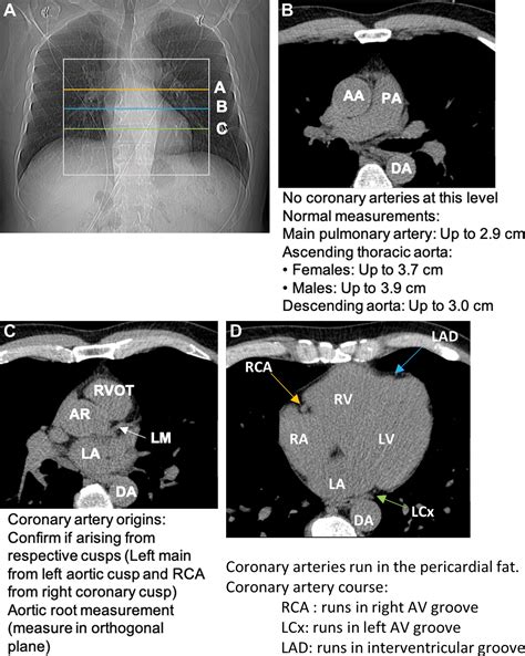 Coronary Artery Calcium Scoring Current Status And Future Directions