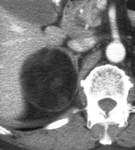 Imaging Of Adrenal Incidentalomas Current Status Ajr