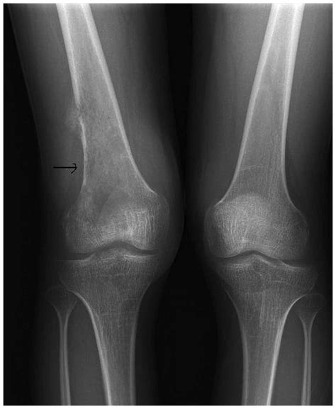 Liposarcoma Radiology