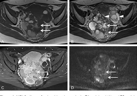 Figure 1 From Polypoid Endometriosis Of The Ovary Mimicking Advanced