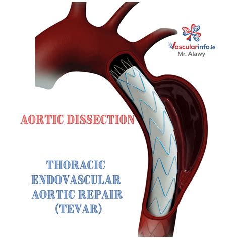 Aortic Dissection Vascular Info