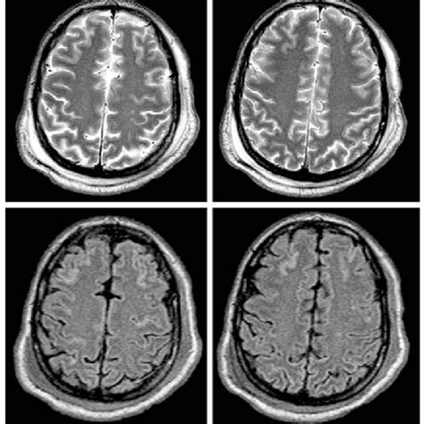 Pdf Sepsis Associated Encephalopathy Studied By Mri And Cerebral