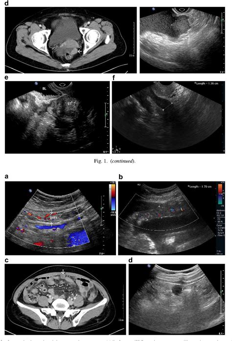 Peritoneal Carcinomatosis In Primary Ovarian Cancer Ultrasound