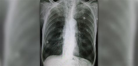 Emphysema causes and symptoms | Respiratory tract disorders and ...