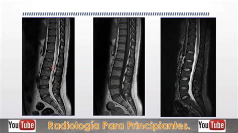 protocolo de adquisición de la Resonancia magnética de Columna lumbar