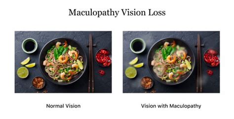 Maculopathy | Vision Loss and Macular Degeneration