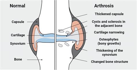 Can CBD Treat Arthrosis?: symptoms, types, treatment - Cannglory