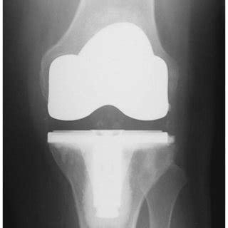 AP radiograph showing a Patellofemoral Arthroplasty. | Download ...