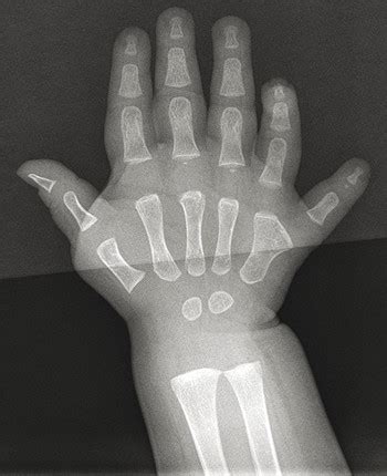 36 Polydactyly | Plastic Surgery Key