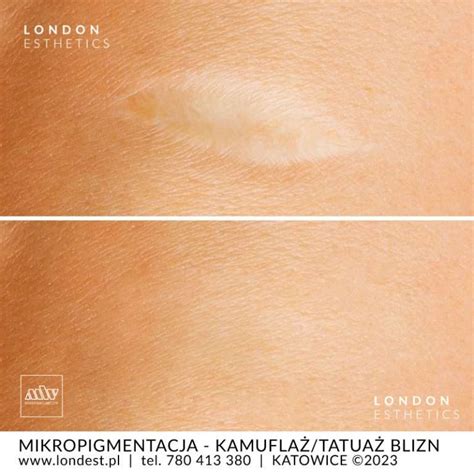 Mikropigmentacja Blizn Tatuaże Na Blizny LONDON ESTHETICS