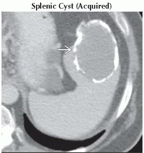 DA8 DB1 Cystic Splenic Mass FFU2 Abdominal Key