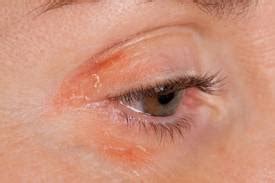 BROW MITES: Itchy Eyelids. Swallen, Red, Flaky Eyelids Treatment