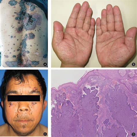 Treatment Of Nevoid Basal Cell Carcinoma Syndrome By Surgery