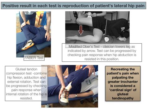 Gluteal Tendinopathy Runningphysio