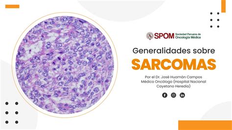 Sarcomas Generalidades Diagn Stico Y Tratamiento Spom