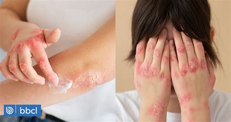 Dermatitis Atópica La Enfermedad Que Afecta A 1 De Cada 10 Niños Estos Son Sus Síntomas