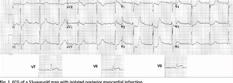 Figure From Posterior Myocardial Infarction With Isolated St