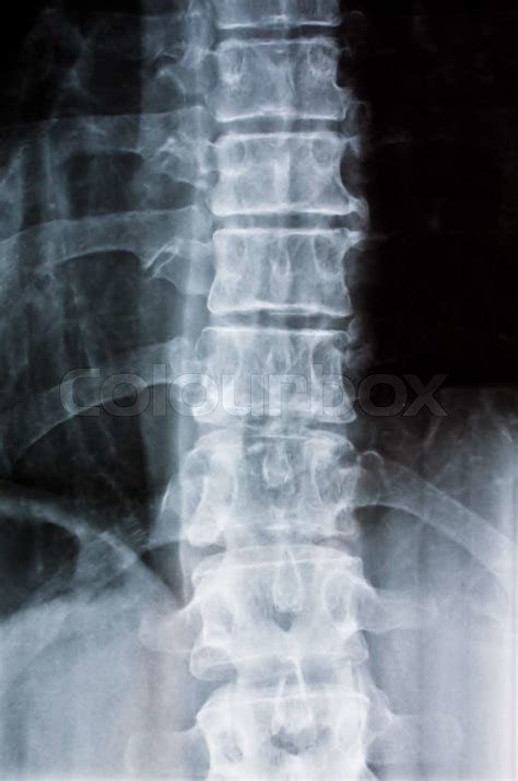 X-ray of a spine. Photo icon for health and disease. | Stock image | Colourbox