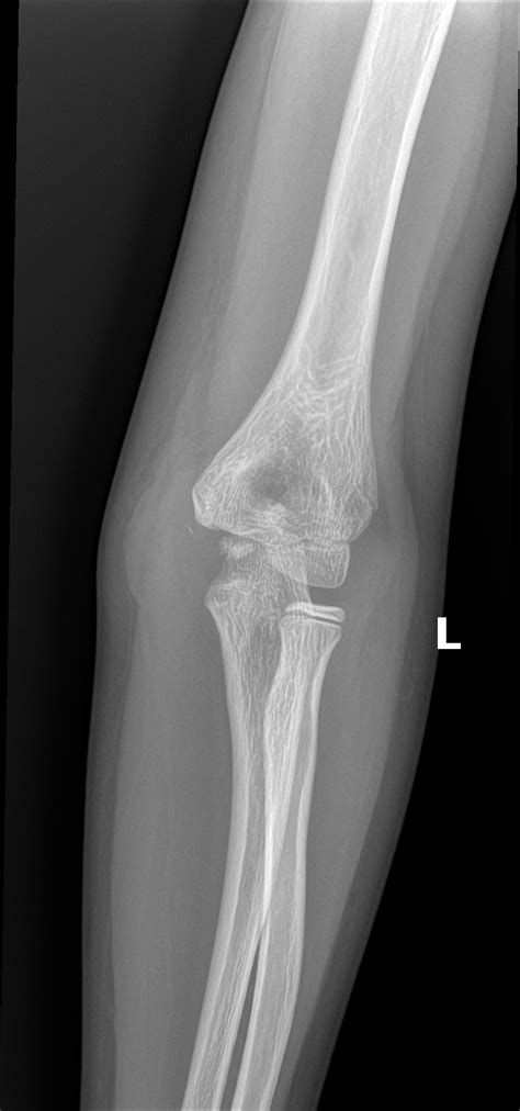 Orthodx Medial Epicondyle Fractures Clinical Advisor