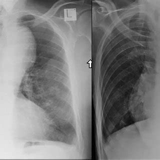 Figure The Patient S Chest X Ray Years Prior Left Showing Moderate